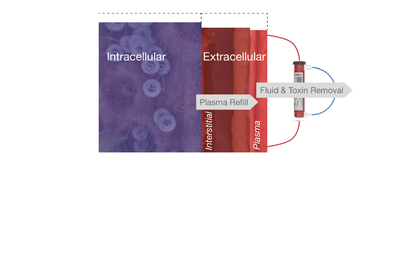 Relative Blood Volume Monitoring for ESKD Fluid Management